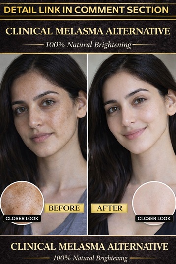 Natural Melasma Reduction with Proven Home Remedies