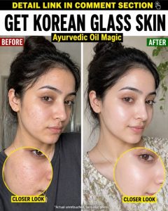 # Achieve Clear Glass Skin with Natural Oils

## Introduction

The image clearly shows a transformation from uneven, acne-prone, textured skin to a smooth, radiant, and luminous complexion often referred to as “glass skin.” The “before” side highlights visible pores, mild acne, redness, and dullness, while the “after” side reflects hydrated, even-toned, and glowing skin.

This type of skin concern is commonly linked to excess oil production, clogged pores, dehydration, and inflammation. While commercial treatments exist, natural remedies rooted in traditional and scientifically supported ingredients can effectively improve skin texture, reduce blemishes, and restore a healthy glow without harsh side effects.

Below are carefully designed remedies tailored to different skin types, ensuring safe and targeted results.

---

## Specific Remedies

### Remedy 1: For Oily Skin

**Ingredients:**

* 1 tablespoon jojoba oil
* 1 teaspoon neem oil
* 1 teaspoon aloe vera gel
* 3 drops tea tree oil
* 1 teaspoon rose water
* 1 teaspoon multani mitti (Fuller’s earth)

#### The Science Behind It

* **Jojoba oil** mimics natural sebum, helping regulate oil production.
* **Neem oil** contains azadirachtin, which has antibacterial and anti-inflammatory properties that reduce acne-causing bacteria.
* **Aloe vera** is rich in polysaccharides that hydrate and calm irritated skin.
* **Tea tree oil** contains terpinen-4-ol, known to kill acne-causing bacteria.
* **Rose water** balances skin pH and tightens pores.
* **Multani mitti** absorbs excess oil and unclogs pores.

**Procedure:**

1. Mix all ingredients into a smooth paste.
2. Apply evenly on the face, focusing on oily areas.
3. Leave for 15 minutes.
4. Rinse with lukewarm water and pat dry.

**How Often to Apply:**
Alternate days for 10–14 days.

**Initial Results:**
Within 2–3 days, oiliness reduces, pores appear tighter, and skin feels fresher.

---

### Remedy 2: For Dry Skin

**Ingredients:**

* 1 tablespoon almond oil
* 1 teaspoon honey
* 1 teaspoon milk cream
* 1 teaspoon mashed avocado
* 3 drops vitamin E oil
* 1 teaspoon sandalwood powder

#### The Science Behind It

* **Almond oil** is rich in fatty acids and vitamin E, improving skin barrier function.
* **Honey** acts as a humectant, drawing moisture into the skin.
* **Milk cream** contains lactic acid, gently exfoliating dead skin cells.
* **Avocado** is packed with biotin and healthy fats for deep nourishment.
* **Vitamin E oil** protects against oxidative stress.
* **Sandalwood powder** soothes dryness and reduces irritation.

**Procedure:**

1. Blend all ingredients into a creamy mixture.
2. Apply generously to clean skin.
3. Leave for 20 minutes.
4. Wash with lukewarm water.

**How Often to Apply:**
3–4 times per week for 14 days.

**Initial Results:**
Skin feels softer and more hydrated within 1–2 days, with reduced flakiness.

---

### Remedy 3: For Combination Skin

**Ingredients:**

* 1 tablespoon argan oil
* 1 teaspoon yogurt
* 1 teaspoon cucumber juice
* 1 teaspoon oatmeal powder
* 2 drops lavender oil
* 1 teaspoon honey

#### The Science Behind It

* **Argan oil** balances both dry and oily areas with essential fatty acids.
* **Yogurt** contains probiotics and lactic acid, improving skin texture.
* **Cucumber juice** hydrates and reduces puffiness.
* **Oatmeal** soothes irritation and gently exfoliates.
* **Lavender oil** has calming and antimicrobial effects.
* **Honey** locks in moisture while preventing bacterial growth.

**Procedure:**

1. Mix ingredients thoroughly.
2. Apply evenly, focusing on both oily and dry zones.
3. Leave for 15–20 minutes.
4. Rinse gently.

**How Often to Apply:**
Every 2 days for 10–12 days.

**Initial Results:**
Balanced hydration and smoother texture noticeable within 3 days.

---

### Remedy 4: For Sensitive Skin

**Ingredients:**

* 1 tablespoon calendula oil
* 1 teaspoon aloe vera gel
* 1 teaspoon chamomile tea (cooled)
* 1 teaspoon rice flour
* 2 drops rose oil
* 1 teaspoon cucumber pulp

#### The Science Behind It

* **Calendula oil** contains flavonoids that reduce inflammation.
* **Aloe vera** soothes redness and promotes healing.
* **Chamomile** has bisabolol, which calms sensitive skin.
* **Rice flour** gently exfoliates without irritation.
* **Rose oil** improves skin tone and reduces sensitivity.
* **Cucumber pulp** cools and hydrates the skin.

**Procedure:**

1. Combine all ingredients into a soft paste.
2. Apply gently without rubbing.
3. Leave for 10–15 minutes.
4. Wash with cool water.

**How Often to Apply:**
3 times a week for 10 days.

**Initial Results:**
Redness and irritation reduce within 2–3 days.

---

### Remedy 5: For Normal Skin

**Ingredients:**

* 1 tablespoon coconut oil
* 1 teaspoon turmeric
* 1 teaspoon honey
* 1 teaspoon lemon juice
* 1 teaspoon gram flour
* 2 drops essential oil (optional)

#### The Science Behind It

* **Coconut oil** provides antimicrobial and moisturizing benefits.
* **Turmeric** contains curcumin, reducing inflammation and pigmentation.
* **Honey** maintains hydration and glow.
* **Lemon juice** provides vitamin C for brightening.
* **Gram flour** exfoliates and removes impurities.
* **Essential oils** enhance skin rejuvenation.

**Procedure:**

1. Mix into a smooth paste.
2. Apply evenly.
3. Leave for 15 minutes.
4. Rinse thoroughly.

**How Often to Apply:**
Twice a week for 14 days.

**Initial Results:**
Visible glow and smoother skin texture within 2–3 days.

---

## Targeted Diet Plan for Healing

### Vegetarian Diet Plan

* Spinach and kale (rich in antioxidants)
* Carrots (high in beta-carotene)
* Almonds and walnuts (healthy fats)
* Lentils and chickpeas (protein for skin repair)
* Papaya (enzymes for skin renewal)
* Green tea (reduces inflammation)

### Non-Vegetarian Diet Plan

* Salmon (omega-3 fatty acids)
* Eggs (biotin and protein)
* Chicken breast (lean protein)
* Tuna (anti-inflammatory nutrients)
* Bone broth (collagen support)
* Yogurt (probiotics for gut health)

### Diabetic-Friendly Diet Plan

* Bitter gourd (blood sugar control)
* Oats (low glycemic index)
* Chia seeds (fiber-rich)
* Broccoli (antioxidant support)
* Flaxseeds (omega-3s)
* Unsweetened yogurt

### Heart Patient-Friendly Diet Plan

* Olive oil (healthy fats)
* Avocado (reduces bad cholesterol)
* Whole grains (fiber-rich)
* Berries (antioxidants)
* Nuts (heart-friendly fats)
* Leafy greens

---

## Final Tips & Conclusion

Healthy, glowing skin is a result of consistent care, proper nutrition, and gentle treatment. Follow these essential tips:

* Always perform a patch test before applying any remedy
* Keep your face clean but avoid over-washing
* Stay hydrated with at least 8–10 glasses of water daily
* Maintain a regular sleep cycle (7–8 hours)
* Avoid harsh chemical products
* Keep pillowcases and skincare tools clean

### Summary

By combining targeted natural remedies based on your skin type with a balanced diet, you can significantly improve skin texture, reduce acne, and achieve a radiant, glass-like glow. These remedies work by restoring hydration, balancing oil production, and reducing inflammation.

### Timeline

Follow this routine consistently for 14 days to see noticeable improvements. Continued use for up to 1 month can enhance and maintain results.

### Medical Disclaimer

If the problem persists after this period, you must see a certified doctor or healthcare professional.
