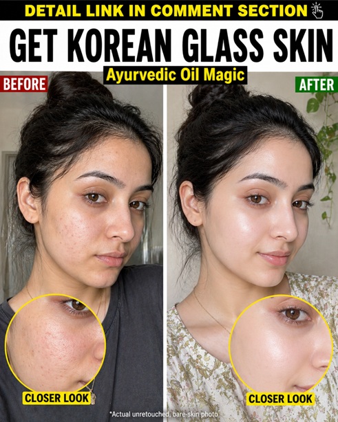 # Achieve Clear Glass Skin with Natural Oils ## Introduction The image clearly shows a transformation from uneven, acne-prone, textured skin to a smooth, radiant, and luminous complexion often referred to as “glass skin.” The “before” side highlights visible pores, mild acne, redness, and dullness, while the “after” side reflects hydrated, even-toned, and glowing skin. This type of skin concern is commonly linked to excess oil production, clogged pores, dehydration, and inflammation. While commercial treatments exist, natural remedies rooted in traditional and scientifically supported ingredients can effectively improve skin texture, reduce blemishes, and restore a healthy glow without harsh side effects. Below are carefully designed remedies tailored to different skin types, ensuring safe and targeted results. --- ## Specific Remedies ### Remedy 1: For Oily Skin **Ingredients:** * 1 tablespoon jojoba oil * 1 teaspoon neem oil * 1 teaspoon aloe vera gel * 3 drops tea tree oil * 1 teaspoon rose water * 1 teaspoon multani mitti (Fuller’s earth) #### The Science Behind It * **Jojoba oil** mimics natural sebum, helping regulate oil production. * **Neem oil** contains azadirachtin, which has antibacterial and anti-inflammatory properties that reduce acne-causing bacteria. * **Aloe vera** is rich in polysaccharides that hydrate and calm irritated skin. * **Tea tree oil** contains terpinen-4-ol, known to kill acne-causing bacteria. * **Rose water** balances skin pH and tightens pores. * **Multani mitti** absorbs excess oil and unclogs pores. **Procedure:** 1. Mix all ingredients into a smooth paste. 2. Apply evenly on the face, focusing on oily areas. 3. Leave for 15 minutes. 4. Rinse with lukewarm water and pat dry. **How Often to Apply:** Alternate days for 10–14 days. **Initial Results:** Within 2–3 days, oiliness reduces, pores appear tighter, and skin feels fresher. --- ### Remedy 2: For Dry Skin **Ingredients:** * 1 tablespoon almond oil * 1 teaspoon honey * 1 teaspoon milk cream * 1 teaspoon mashed avocado * 3 drops vitamin E oil * 1 teaspoon sandalwood powder #### The Science Behind It * **Almond oil** is rich in fatty acids and vitamin E, improving skin barrier function. * **Honey** acts as a humectant, drawing moisture into the skin. * **Milk cream** contains lactic acid, gently exfoliating dead skin cells. * **Avocado** is packed with biotin and healthy fats for deep nourishment. * **Vitamin E oil** protects against oxidative stress. * **Sandalwood powder** soothes dryness and reduces irritation. **Procedure:** 1. Blend all ingredients into a creamy mixture. 2. Apply generously to clean skin. 3. Leave for 20 minutes. 4. Wash with lukewarm water. **How Often to Apply:** 3–4 times per week for 14 days. **Initial Results:** Skin feels softer and more hydrated within 1–2 days, with reduced flakiness. --- ### Remedy 3: For Combination Skin **Ingredients:** * 1 tablespoon argan oil * 1 teaspoon yogurt * 1 teaspoon cucumber juice * 1 teaspoon oatmeal powder * 2 drops lavender oil * 1 teaspoon honey #### The Science Behind It * **Argan oil** balances both dry and oily areas with essential fatty acids. * **Yogurt** contains probiotics and lactic acid, improving skin texture. * **Cucumber juice** hydrates and reduces puffiness. * **Oatmeal** soothes irritation and gently exfoliates. * **Lavender oil** has calming and antimicrobial effects. * **Honey** locks in moisture while preventing bacterial growth. **Procedure:** 1. Mix ingredients thoroughly. 2. Apply evenly, focusing on both oily and dry zones. 3. Leave for 15–20 minutes. 4. Rinse gently. **How Often to Apply:** Every 2 days for 10–12 days. **Initial Results:** Balanced hydration and smoother texture noticeable within 3 days. --- ### Remedy 4: For Sensitive Skin **Ingredients:** * 1 tablespoon calendula oil * 1 teaspoon aloe vera gel * 1 teaspoon chamomile tea (cooled) * 1 teaspoon rice flour * 2 drops rose oil * 1 teaspoon cucumber pulp #### The Science Behind It * **Calendula oil** contains flavonoids that reduce inflammation. * **Aloe vera** soothes redness and promotes healing. * **Chamomile** has bisabolol, which calms sensitive skin. * **Rice flour** gently exfoliates without irritation. * **Rose oil** improves skin tone and reduces sensitivity. * **Cucumber pulp** cools and hydrates the skin. **Procedure:** 1. Combine all ingredients into a soft paste. 2. Apply gently without rubbing. 3. Leave for 10–15 minutes. 4. Wash with cool water. **How Often to Apply:** 3 times a week for 10 days. **Initial Results:** Redness and irritation reduce within 2–3 days. --- ### Remedy 5: For Normal Skin **Ingredients:** * 1 tablespoon coconut oil * 1 teaspoon turmeric * 1 teaspoon honey * 1 teaspoon lemon juice * 1 teaspoon gram flour * 2 drops essential oil (optional) #### The Science Behind It * **Coconut oil** provides antimicrobial and moisturizing benefits. * **Turmeric** contains curcumin, reducing inflammation and pigmentation. * **Honey** maintains hydration and glow. * **Lemon juice** provides vitamin C for brightening. * **Gram flour** exfoliates and removes impurities. * **Essential oils** enhance skin rejuvenation. **Procedure:** 1. Mix into a smooth paste. 2. Apply evenly. 3. Leave for 15 minutes. 4. Rinse thoroughly. **How Often to Apply:** Twice a week for 14 days. **Initial Results:** Visible glow and smoother skin texture within 2–3 days. --- ## Targeted Diet Plan for Healing ### Vegetarian Diet Plan * Spinach and kale (rich in antioxidants) * Carrots (high in beta-carotene) * Almonds and walnuts (healthy fats) * Lentils and chickpeas (protein for skin repair) * Papaya (enzymes for skin renewal) * Green tea (reduces inflammation) ### Non-Vegetarian Diet Plan * Salmon (omega-3 fatty acids) * Eggs (biotin and protein) * Chicken breast (lean protein) * Tuna (anti-inflammatory nutrients) * Bone broth (collagen support) * Yogurt (probiotics for gut health) ### Diabetic-Friendly Diet Plan * Bitter gourd (blood sugar control) * Oats (low glycemic index) * Chia seeds (fiber-rich) * Broccoli (antioxidant support) * Flaxseeds (omega-3s) * Unsweetened yogurt ### Heart Patient-Friendly Diet Plan * Olive oil (healthy fats) * Avocado (reduces bad cholesterol) * Whole grains (fiber-rich) * Berries (antioxidants) * Nuts (heart-friendly fats) * Leafy greens --- ## Final Tips & Conclusion Healthy, glowing skin is a result of consistent care, proper nutrition, and gentle treatment. Follow these essential tips: * Always perform a patch test before applying any remedy * Keep your face clean but avoid over-washing * Stay hydrated with at least 8–10 glasses of water daily * Maintain a regular sleep cycle (7–8 hours) * Avoid harsh chemical products * Keep pillowcases and skincare tools clean ### Summary By combining targeted natural remedies based on your skin type with a balanced diet, you can significantly improve skin texture, reduce acne, and achieve a radiant, glass-like glow. These remedies work by restoring hydration, balancing oil production, and reducing inflammation. ### Timeline Follow this routine consistently for 14 days to see noticeable improvements. Continued use for up to 1 month can enhance and maintain results. ### Medical Disclaimer If the problem persists after this period, you must see a certified doctor or healthcare professional.