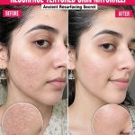 Ancient Techniques to Resurface Textured Skin Naturally