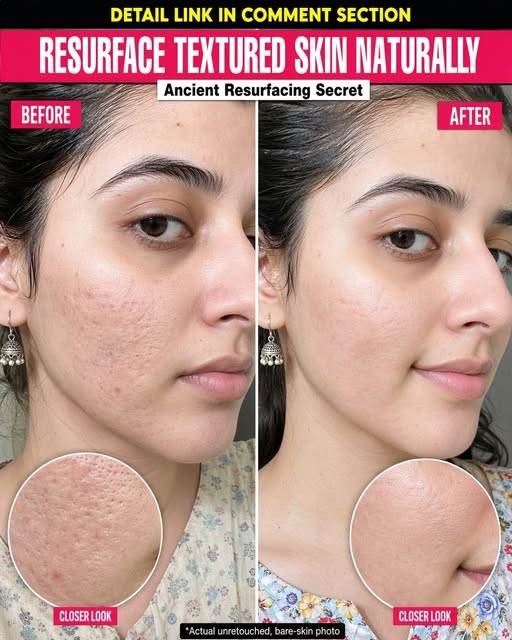 Ancient Techniques to Resurface Textured Skin Naturally