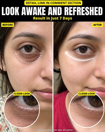 Brighten Dark Under Eyes Naturally in 7 Days