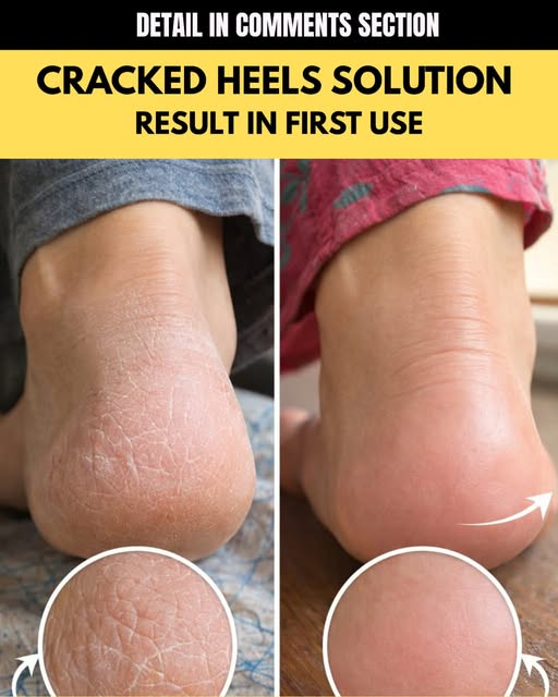 Cracked Heels Solution Result in First Use
