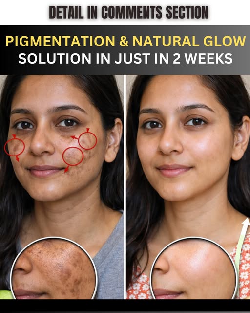 Effective Home Remedies for Facial Pigmentation Glow
