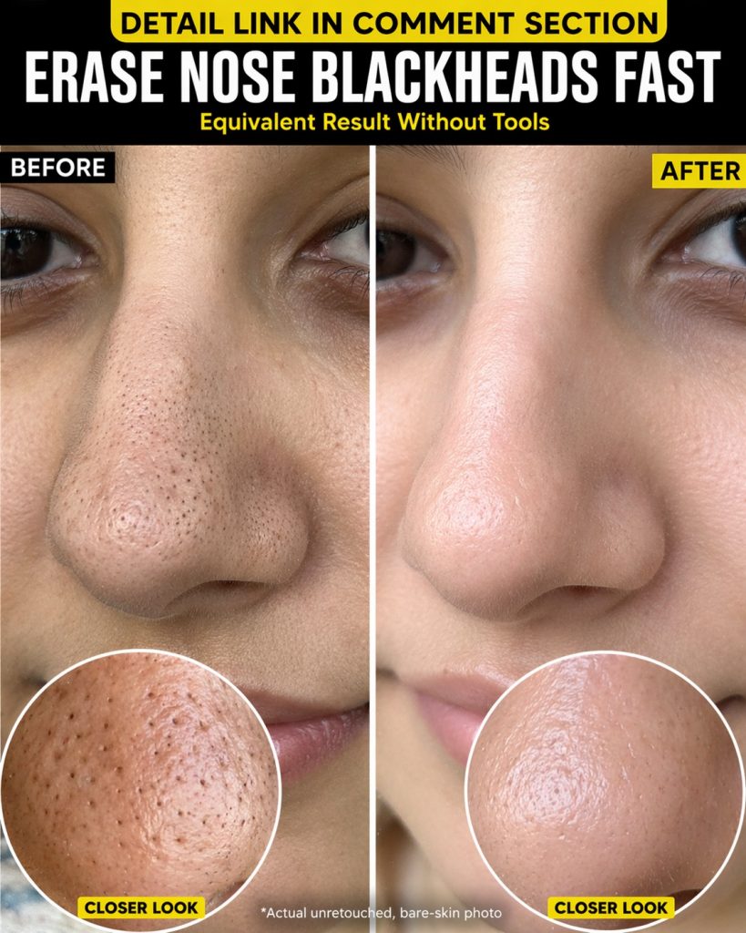 Fast Natural Remedies to Remove Nose Blackheads