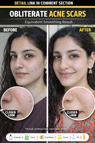 How to Naturally Reduce Acne Scars Effectively