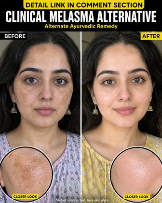 Natural Ayurvedic Solutions to Reduce Facial Melasma