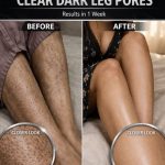 Natural Remedies to Clear Dark Leg Pores Fast