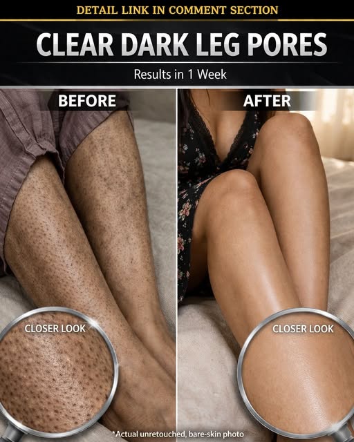 Natural Remedies to Clear Dark Leg Pores Fast