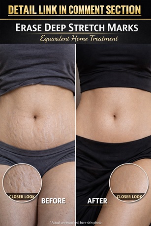 Natural Ways to Fade Deep Stretch Marks