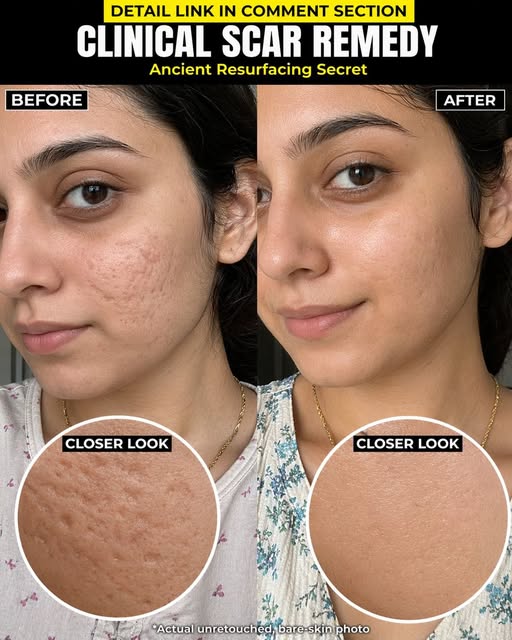 Natural Ways to Smooth Acne Scars Effectively