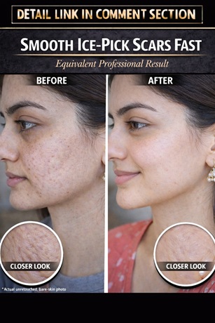 Natural Ways to Smooth Ice-Pick Acne Scars Safely