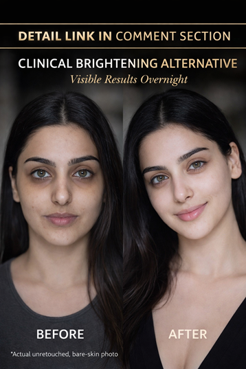# Overnight Glow Remedies for Dull Uneven Skin ## Introduction The image clearly depicts dull, uneven skin tone with mild pigmentation and lack of radiance in the “before” state, followed by a brighter, smoother, and more even complexion in the “after” state. This condition is typically associated with accumulated dead skin cells, dehydration, oxidative stress, and reduced cellular turnover. While “overnight” transformations are often exaggerated, targeted natural remedies can significantly improve skin clarity, hydration, and brightness within a short time when applied correctly. This article provides scientifically grounded, skin-type-specific remedies that work to restore natural glow, improve texture, and gradually correct uneven tone without damaging the skin barrier. --- ## Specific Remedies ### Remedy 1: For Oily Skin **Ingredients:** * 1 tablespoon aloe vera gel * 1 teaspoon lemon juice * 1 teaspoon green tea extract * 1 teaspoon rice flour * 3–4 drops tea tree oil * 1 teaspoon rose water #### The Science Behind It Aloe vera contains polysaccharides that hydrate without clogging pores while reducing inflammation. Lemon juice delivers vitamin C, which inhibits melanin synthesis by blocking tyrosinase activity. Green tea is rich in EGCG (epigallocatechin gallate), reducing sebum production and oxidative stress. Rice flour provides mild physical exfoliation and contains ferulic acid for brightening. Tea tree oil has antimicrobial properties that prevent acne-related pigmentation. Rose water tones and balances oil production. **Procedure:** Mix all ingredients into a smooth paste. Apply evenly on clean skin and leave for 12–15 minutes. Rinse with cool water. **How Often to Apply:** Every alternate night for 10–14 days **Initial Results:** Within 1–2 days, excess oil reduces and skin appears fresher and less congested. --- ### Remedy 2: For Dry Skin **Ingredients:** * 1 tablespoon fresh cream * 1 teaspoon honey * 1 teaspoon almond oil * 1 tablespoon mashed papaya * 1 teaspoon oats powder * 2 drops glycerin #### The Science Behind It Fresh cream is rich in lipids that repair the skin barrier. Honey attracts moisture and enhances hydration. Almond oil provides vitamin E to repair pigmentation damage. Papaya contains papain enzyme, which exfoliates dead skin cells and improves radiance. Oats act as a gentle exfoliant and anti-inflammatory agent. Glycerin draws water into the skin, improving plumpness and glow. **Procedure:** Blend ingredients into a creamy mask. Apply gently and leave for 15–20 minutes before rinsing with lukewarm water. **How Often to Apply:** Daily at night for 7–10 days **Initial Results:** Within the first application, skin feels softer and visibly more hydrated. --- ### Remedy 3: For Combination Skin **Ingredients:** * 1 tablespoon yogurt * 1 teaspoon turmeric * 1 teaspoon honey * 1 teaspoon cucumber juice * 1 teaspoon gram flour * 1 teaspoon rose water #### The Science Behind It Yogurt contains lactic acid for mild exfoliation and microbiome support. Turmeric’s curcumin reduces inflammation and pigmentation. Honey balances hydration across dry and oily areas. Cucumber juice cools and soothes the skin. Gram flour removes impurities without stripping essential oils. Rose water helps maintain pH balance. **Procedure:** Mix thoroughly and apply evenly. Leave for 15 minutes and rinse with cool water. **How Often to Apply:** 3 times a week for 2 weeks **Initial Results:** Within 2–3 days, skin texture becomes smoother and tone begins to even out. --- ### Remedy 4: For Sensitive Skin **Ingredients:** * 2 tablespoons aloe vera gel * 1 teaspoon chamomile tea * 1 teaspoon cucumber pulp * 1 teaspoon rice water * 2 drops vitamin E oil #### The Science Behind It Aloe vera reduces inflammation and supports healing. Chamomile contains flavonoids that calm irritation and redness. Cucumber pulp hydrates and cools sensitive skin. Rice water is rich in inositol, which promotes skin repair and brightness. Vitamin E acts as an antioxidant, protecting against environmental damage. **Procedure:** Combine ingredients gently and apply without rubbing. Leave for 10–12 minutes before rinsing. **How Often to Apply:** 2–3 times a week for 10 days **Initial Results:** Redness reduces within 1–2 days, and skin appears calmer and more balanced. --- ### Remedy 5: For Normal Skin **Ingredients:** * 1 tablespoon sandalwood powder * 1 teaspoon honey * 1 teaspoon lemon juice * 1 tablespoon milk * 1 teaspoon rose water #### The Science Behind It Sandalwood has natural brightening and anti-inflammatory properties. Honey hydrates and enhances skin repair. Lemon juice reduces pigmentation through vitamin C. Milk contains lactic acid for gentle exfoliation. Rose water refreshes and tones the skin. **Procedure:** Mix into a paste and apply evenly. Leave for 15 minutes and rinse thoroughly. **How Often to Apply:** 3–4 times a week for 2 weeks **Initial Results:** Within 2–3 days, skin looks brighter and more even. --- ## Targeted Exercise Routine Improving blood circulation is essential for enhancing natural skin glow and supporting detoxification. **1. Facial Oxygenation Exercise** * Inhale deeply and puff cheeks * Hold for 10 seconds * Release slowly * Repeat 10 times **Mechanism:** Increases oxygen supply to skin cells, enhancing radiance. **2. Neck Lift Stretch** * Tilt head backward * Stretch lips forward * Hold for 10 seconds * Repeat 10 times **Mechanism:** Improves lymphatic drainage and reduces toxin accumulation. **3. Face Tapping Massage** * Gently tap entire face with fingertips * Continue for 2–3 minutes **Mechanism:** Stimulates microcirculation and collagen activity. Perform daily for 10–15 minutes. --- ## Targeted Diet Plan for Healing ### Vegetarian Diet Plan * Spinach and broccoli for antioxidants * Carrots and sweet potatoes for beta-carotene * Citrus fruits for vitamin C * Nuts and seeds for healthy fats * Green tea for detoxification * Lentils for protein and repair ### Non-Vegetarian Diet Plan * Salmon for omega-3 fatty acids * Eggs for protein and biotin * Chicken for collagen support * Tuna for selenium * Yogurt for probiotics * Bone broth for skin elasticity ### Diabetic-Friendly Diet Plan * Whole grains like oats * Leafy greens * Chia seeds * Bitter gourd * Unsweetened yogurt * Lentils ### Heart Patient-Friendly Diet Plan * Oats and barley * Olive oil * Avocados * Berries * Green tea * Almonds --- ## Final Tips & Conclusion Consistent care is the key to achieving an even and radiant skin tone. Always cleanse gently, avoid excessive sun exposure, and stay hydrated. Sleep plays a crucial role in skin repair, so ensure 7–8 hours of rest daily. Avoid over-exfoliation, as it can worsen pigmentation. Maintain clean skincare tools and perform a patch test before using any remedy. **Summary:** By combining natural remedies tailored to your skin type, simple facial exercises, and a nutrient-rich diet, you can significantly improve uneven skin tone and achieve a healthier glow. **Timeline:** Follow this routine consistently for 14 days, with noticeable improvement starting within the first few applications. Continue for up to 4 weeks for sustained results. **Mandatory Medical Disclaimer:** If the problem persists after this period, you must see a certified doctor or healthcare professional.