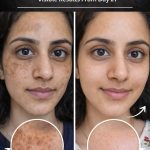 Remove Deep Sun Damage Naturally and Safely