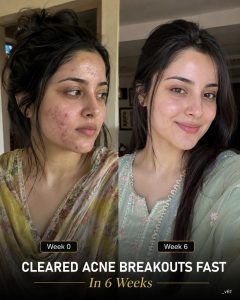 Cleared Acne Breakouts Fast in 6 Weeks Naturally by Skin Type
