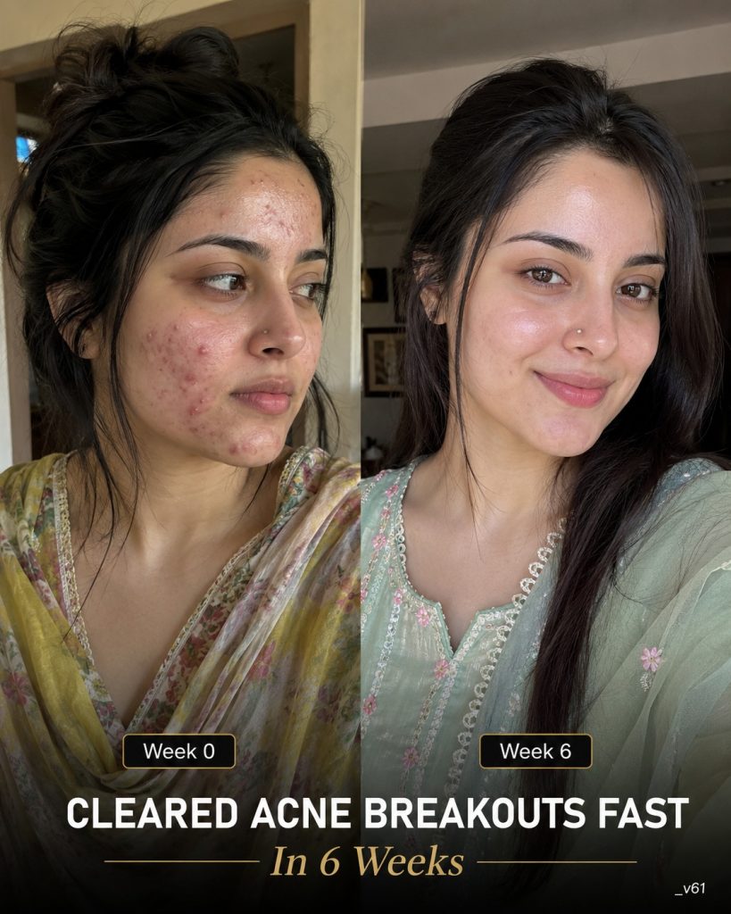 Cleared Acne Breakouts Fast in 6 Weeks Naturally by Skin Type