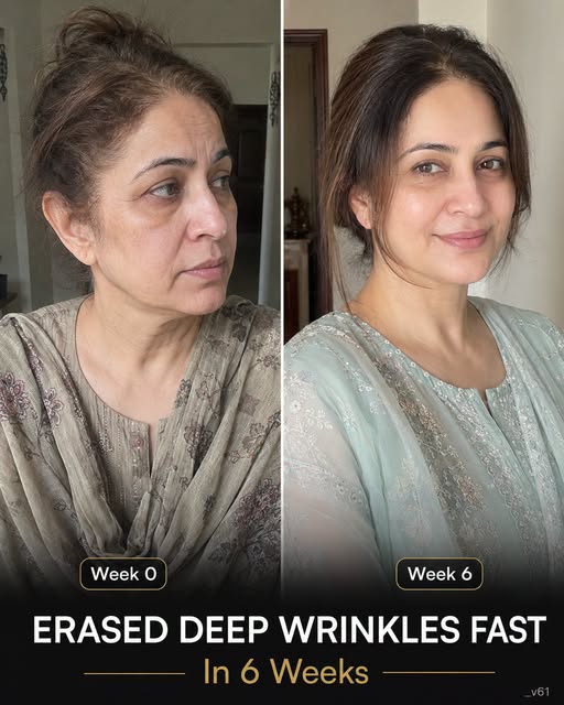 Erase Deep Wrinkles Fast in 6 Weeks Naturally by Skin Type