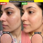 Erase Large Cheek Pores Fast Naturally