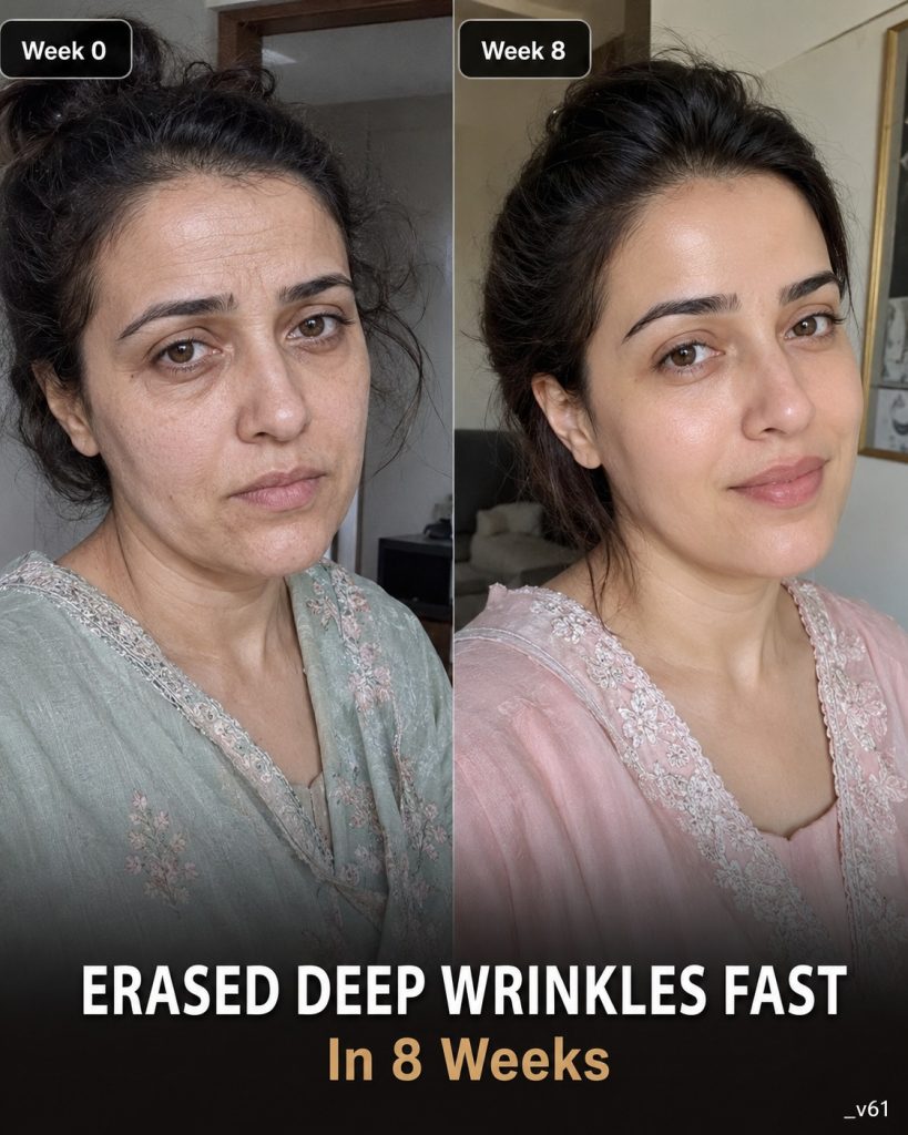 Erased Deep Wrinkles Fast in 8 Weeks Naturally