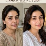 Naturally Younger, Smoother Skin in 5 Weeks