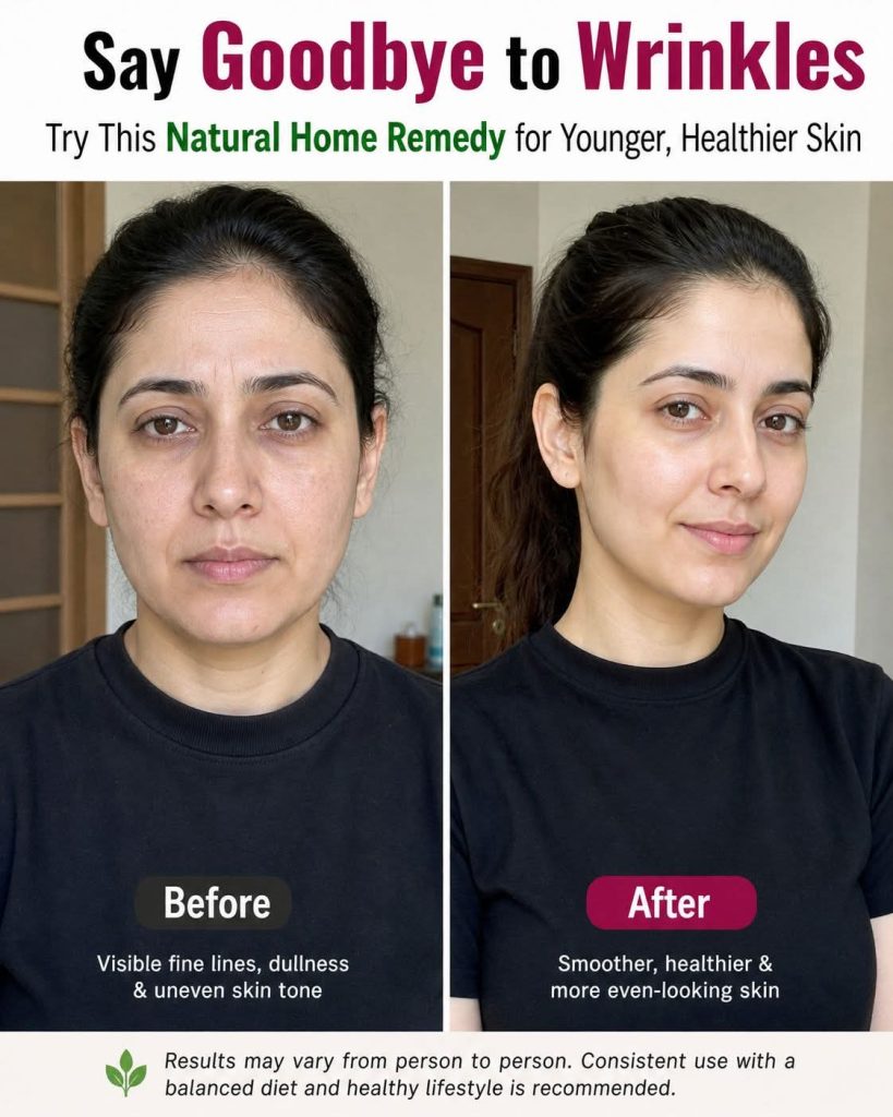 Reverse Premature Wrinkles Naturally at Home with Scientifically Backed RemediesReverse Premature Wrinkles Naturally at Home with Scientifically Backed Remedies