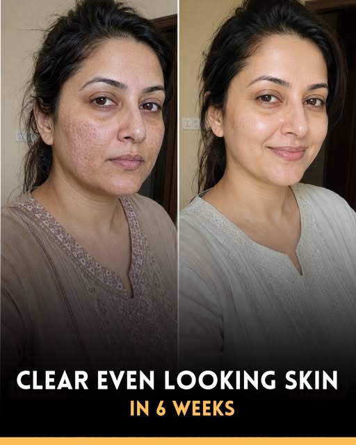 Uneven skin tone, post-acne marks, dullness, and rough texture can make the skin appear older and less radiant. While professional treatments may help, many people prefer natural approaches that support the skin’s own healing process.