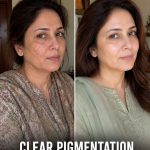 Clear Pigmentation Naturally in 4 Weeks Using Traditional Kitchen Remedies