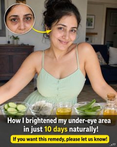 Brighten Dark Under-Eye Circles Naturally in 10 Days: Skin-Type-Based Home Remedies for a Refreshed Look