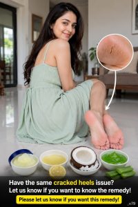 Have the Same Cracked Heels Issue? Try This Traditional Home Remedy