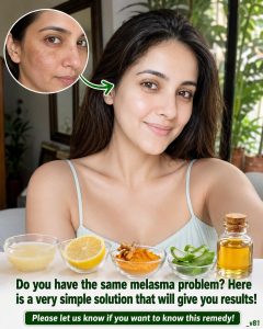 Natural Remedy for Melasma Using Lemon, Turmeric, Aloe Vera and Olive Oil
