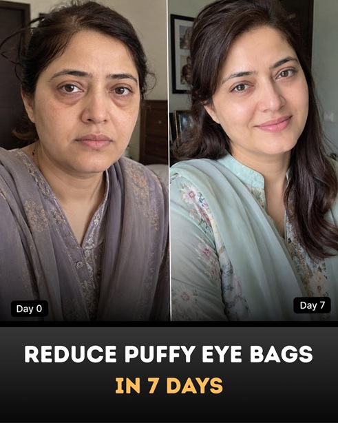 Reduce Puffy Eye Bags Naturally in 7 Days: Proven Home Remedies by Skin Type