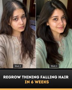 Regrow Thinning and Falling Hair Naturally in 6 Weeks Science-Backed Home Remedies