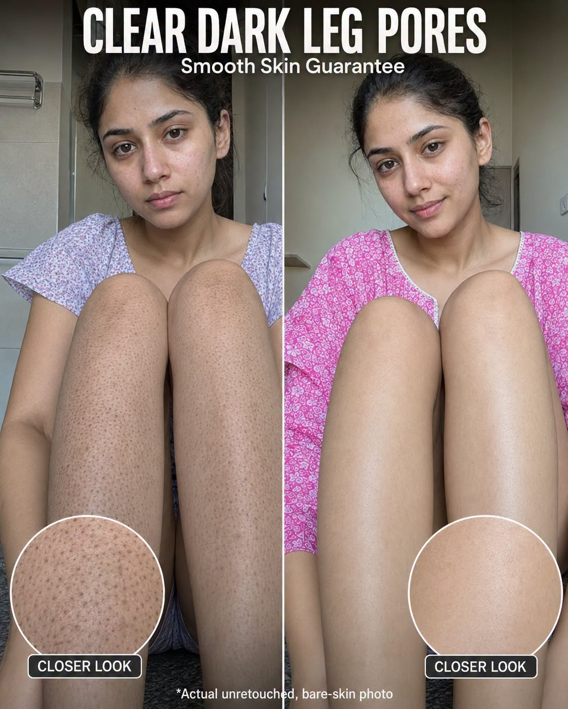 Clear Dark Leg Pores Naturally: 5 Science-Backed Home Remedies for Smooth, Even-Toned Legs